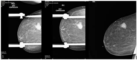 spot compression test on breast|spot compression mammogram vs ultrasound.